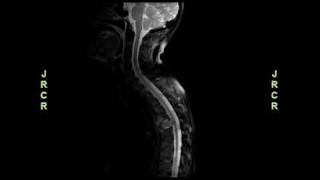 Radiology video Aggressive Adenoid Cystic Carcinoma With Asymptomatic Spinal Cord Compression [upl. by Siurad230]