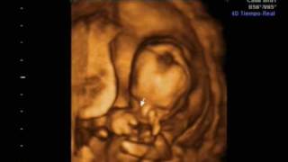 Ecografia 16 semanas 4D y 2D Ultrasound Irati [upl. by Marpet]