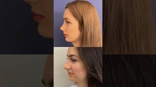 Rhinoplasty Result 👃🏻 Dr Ahmet Dilber rhinoplastyturkey rhinoplasty rhinoplastyistanbul [upl. by Ano]