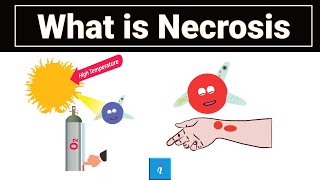 Necrosis  What is Necrosis In Pathology [upl. by Neroc]