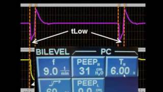 APRV BiLevel BiVent amp DuoPAP 2 [upl. by Bradley]