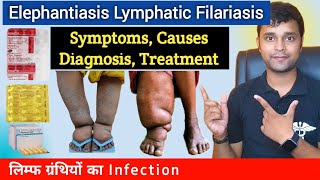 Elephantiasis  Filariasis  Symptoms Causes Diagnosis Treatment Prevention In Hindi [upl. by Theis]