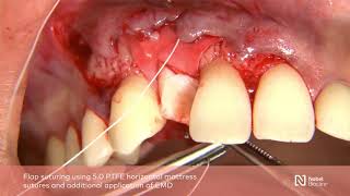 Guided bone regeneration with simultaneous implant placement [upl. by Ihsoyim]