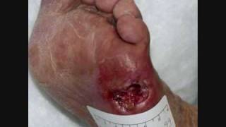 Diabetic Foot Care [upl. by Marchelle]