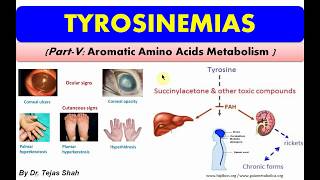 Tyrosinemias II Inborn errors of Aromatic Amino Acids Metabolism II Biochemistry II Dr Tejas Shah [upl. by Fellows]