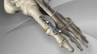 First Metatarsophalangeal Joint Fusion with Arthrex® MTP Fusion Plate [upl. by Brazee]