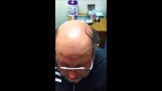 Integrating Scalp Acupuncture and Speech Therapy for Treatment of Dysarthria with GREAT result [upl. by Marijo79]