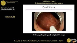 Standard polypectomy techniques Choosing the right technnique [upl. by Nance]