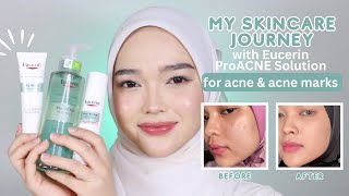 My skincare routine with Eucerin ProACNE Solution for acne and acne marks [upl. by Marquita]