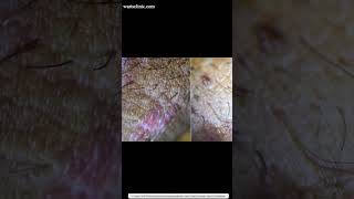 Failed cautery Burning HPV warts conversation with real patient recovered after 1 session HPV BCR™️ [upl. by Ozneral679]