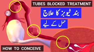 Tubes Blocked Treatment How To Conceive Pregnancy With Blocked Fallopian Tubes Band Tubes ka ilaj [upl. by Eilama]