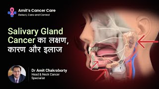 Salivary Gland Cancer  Causes Symptoms amp treatment Explained by Dr Amit Chakraborty [upl. by Ganny]