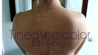 Tinea Versicolor Part 1  TNBeauty94 [upl. by Featherstone]