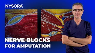 Sciatic  Femoral Nerve Blocks for AKA Amputation [upl. by Yecies]