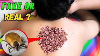 How to remove big ticks on the human body  ticks removal [upl. by Woody]