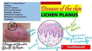 Oral Lichen planus Part 2  Oral manifestations  Histopathology Diagnosis amp Treatment [upl. by Mastic401]