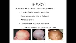 Neurology Hydrocephalus part 2 [upl. by Quartet280]