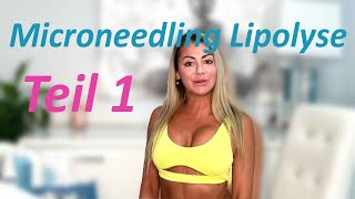 MICRONEEDLING BODY LIPOLYSE [upl. by Yesnil29]