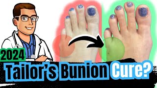 Bunionette Tailors Bunion Surgery Corrector Splints amp Treatment [upl. by Semele]