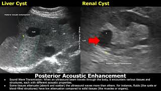 Why Does Posterior Acoustic Enhancement Appear Bright Ultrasound Artifacts  Fluid Filled Spaces [upl. by Lemar394]