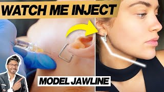 Jaw Filler Before amp After With Procedure  Technique Needle [upl. by Ailsa]