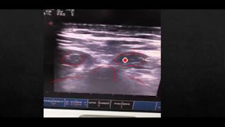 Paraspinal needle Electromyography testing procedure [upl. by Corin]