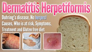 Dermatitis herpetiformis Causes Symptoms Treatment and glutenfree diet list  Duhring’s disease [upl. by Nelie658]