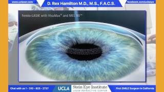 LASIK  Laser Eye Procedure in Dubai [upl. by Yeh657]