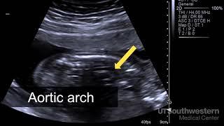 Understanding your fetal ultrasound [upl. by Alletsirhc]