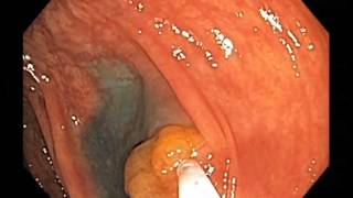 Colonoscopy ChannelEMR Learning  Lesion 122312B [upl. by Lyell]