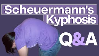 Common Questions About Scheuermanns Kyphosis [upl. by Nelrsa641]