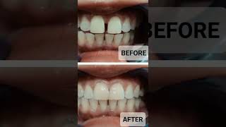 Diastema closure  Dokter Gigi Cuspaeni dentalcare dentist doktergigiindramayu directcomposite [upl. by Eckart]