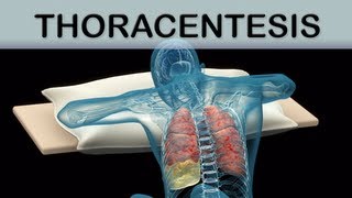 Thoracentesis Medical Animation [upl. by Ssor]