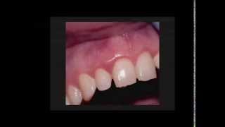 Precise LTM Periodontal Curretage Clinical Procedure [upl. by Salem860]