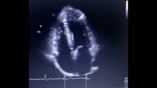 Echocardiography wall motion abnormality NormokinesiaSafaMedicalLecture [upl. by Platus64]