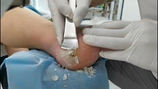 Remove Heel Fissure slowly amp carefully Cracked heel treatment amp Callus removal Dead skin removal [upl. by Lerak578]