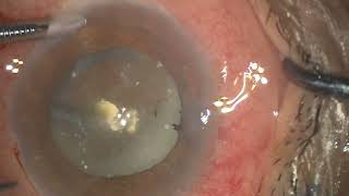 A most effective technique to manage Morgagnian hypermature cataract [upl. by Vasilis]