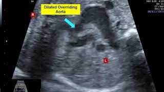 TETRALOGY OF FALLOT WİTH PULMONARY STENOSİS FETAL ECHOCARDİOGRAPHY [upl. by Volney]