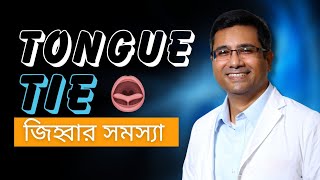 Tongue tie Laser surgery  লেজারের মাধ্যমে টাং টাই সার্জারি [upl. by Greenland]