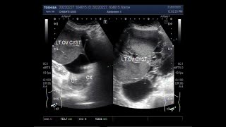 Complex ovarian Mass in a patient aged about 84 years [upl. by Schaab505]