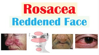 Rosacea Red Lesions on Face  Causes Triggers Types Signs amp Symptoms Diagnosis Treatment [upl. by Greenman27]