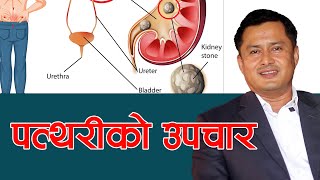 मिर्गौला र मुत्र नलिको पत्थरी भए कसरी उपचार गर्ने Prof Dr Sudip Raj KC  NIKO NEPAL [upl. by Metah]