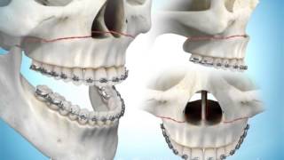 Maxillary Advancement Surgery [upl. by Sinnard727]