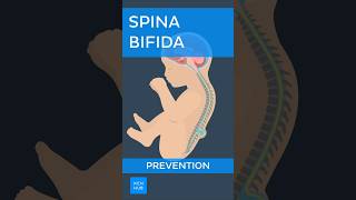 Spina bifida Prevention  Kenhub spinabifida [upl. by Allis]