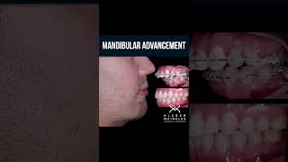 MANDIBULAR ADVANCEMENT  ORTHODONTIC TIPS Shorts [upl. by Nnauol]