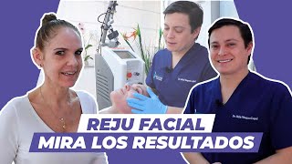 Testimonio de Carmen Abad Schoster Rejuvenecimiento Facial [upl. by Vrablik]