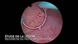 chirurgie endoscopique  résection de polype de vessie par voie transurétral [upl. by Pauwles]