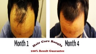 Homeopathic Medicine For Alopecia and Baldness  Hair Care Bangla [upl. by Brandie]