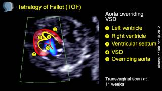 Tetralogy of Fallot TOF echo at 11 weeks [upl. by Kenwrick956]