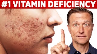 The Top Vitamin Deficiency with Acne [upl. by Nairb553]